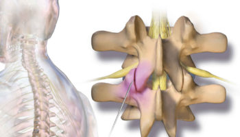 facet joint injection