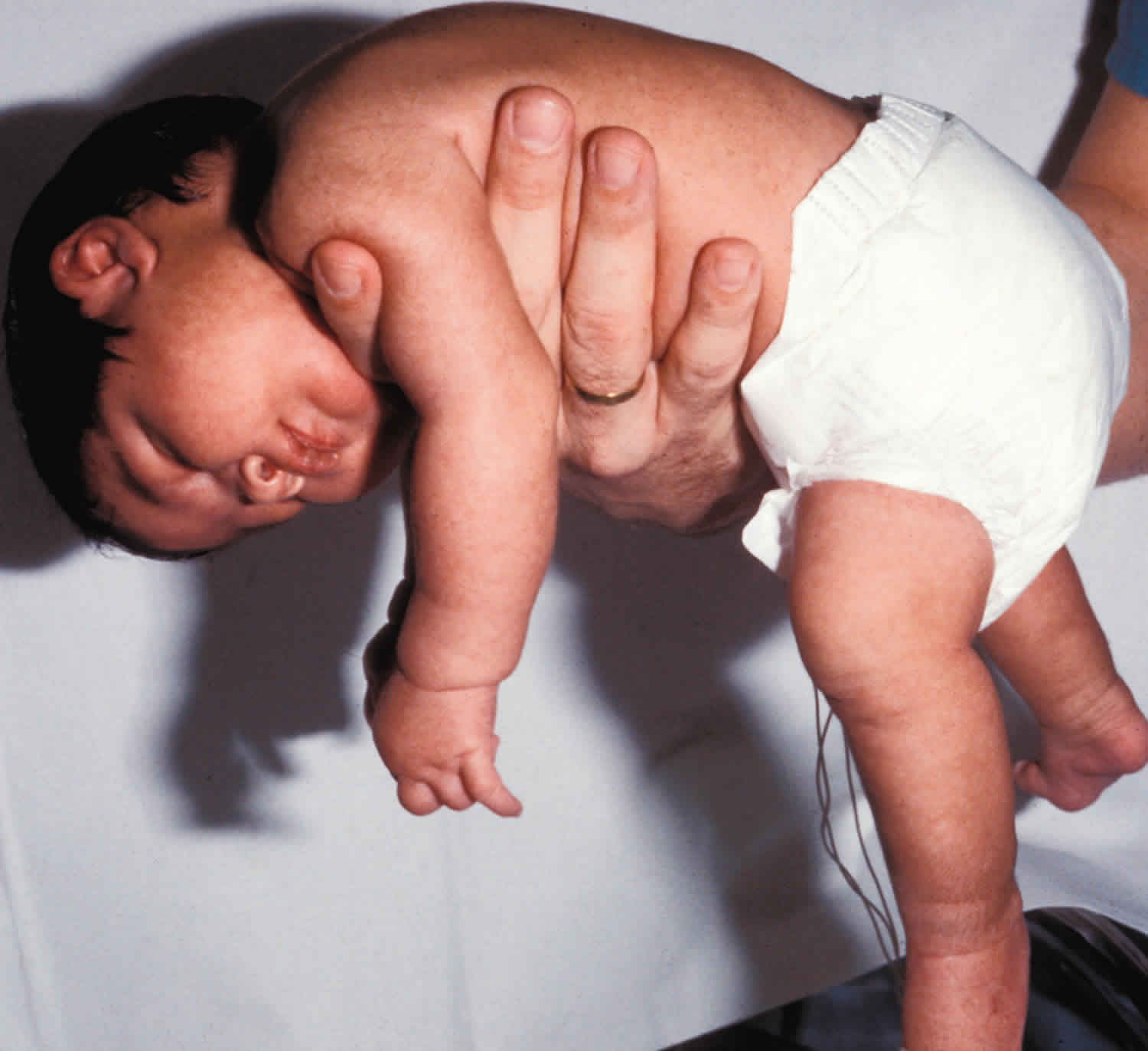 Floppy baby syndrome causes, signs, symptoms, diagnosis ...