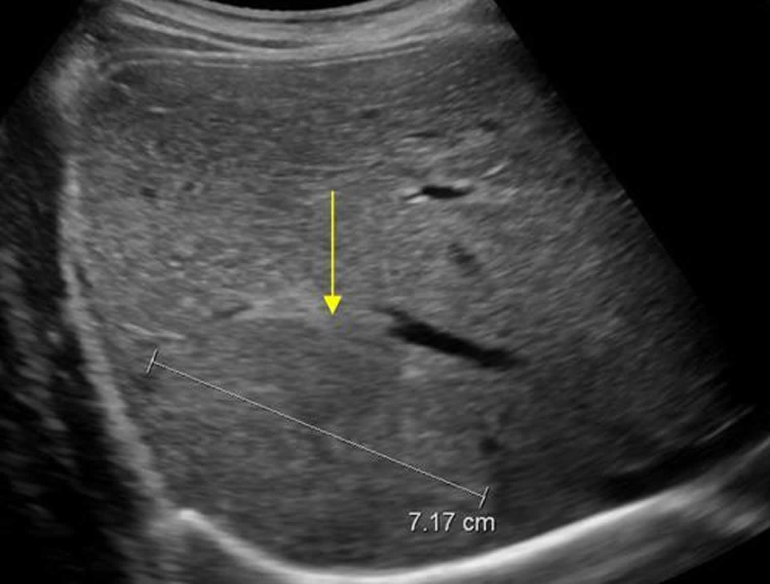 Focal Nodular Hyperplasia Liver Causes Symptoms Diagnosis And Treatment