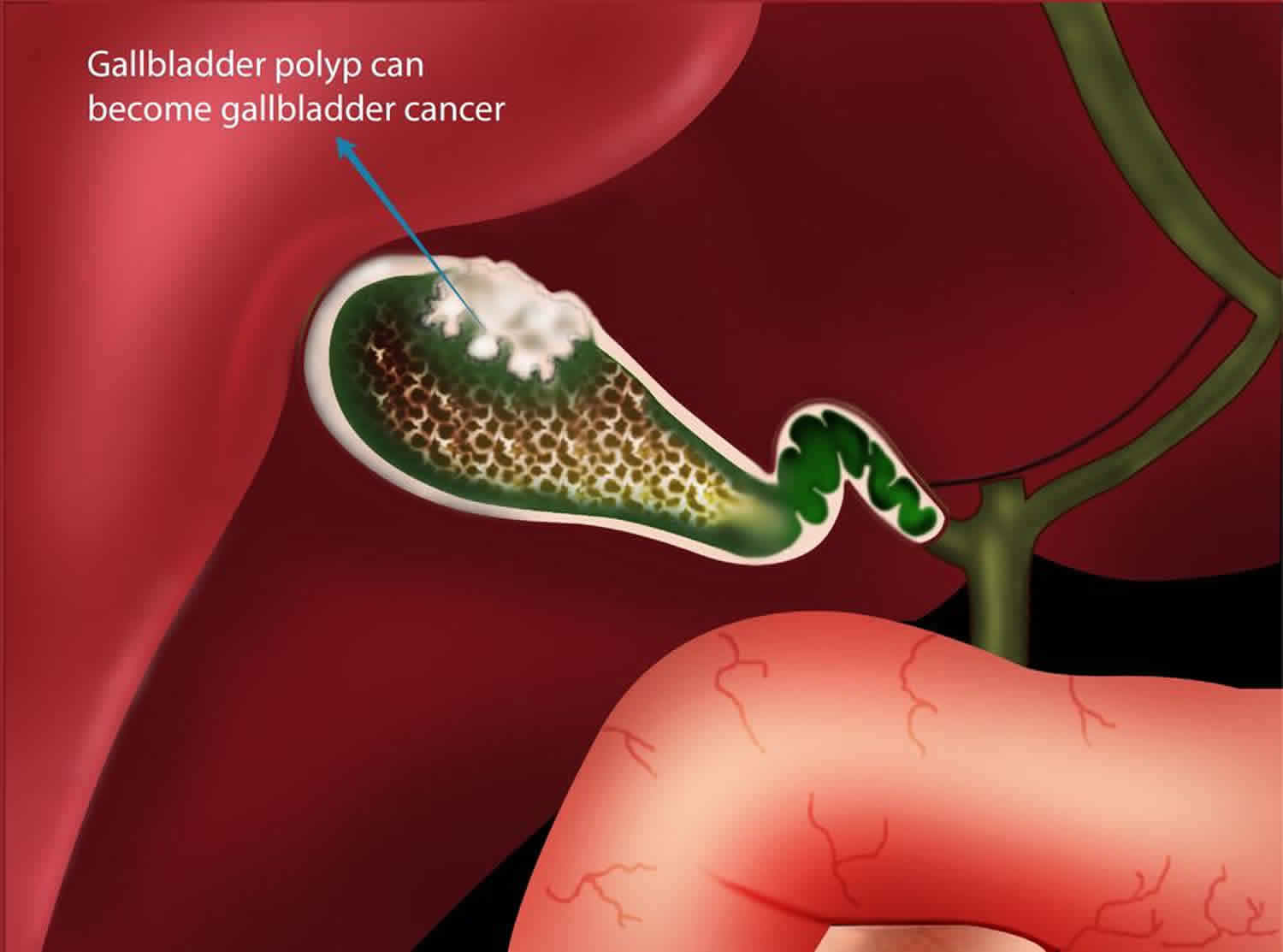 Gallbladder Polyps Ultrasound