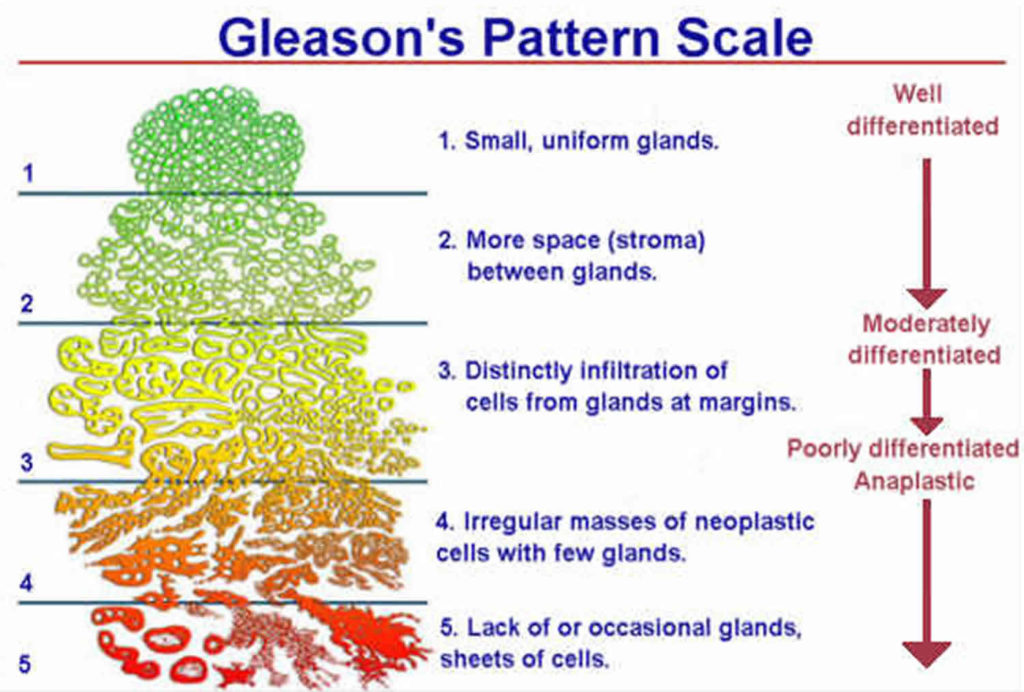 Prostate cancer gleason score