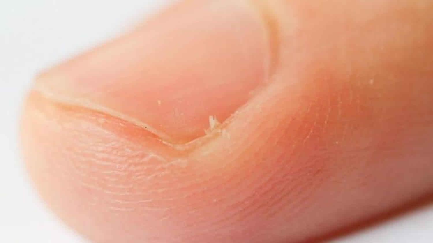 Hangnail Infected Hangnail Causes Symptoms Diagnosis Treatment