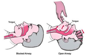 Head Tilt Chin Lift Maneuver & Jaw Thrust Maneuver