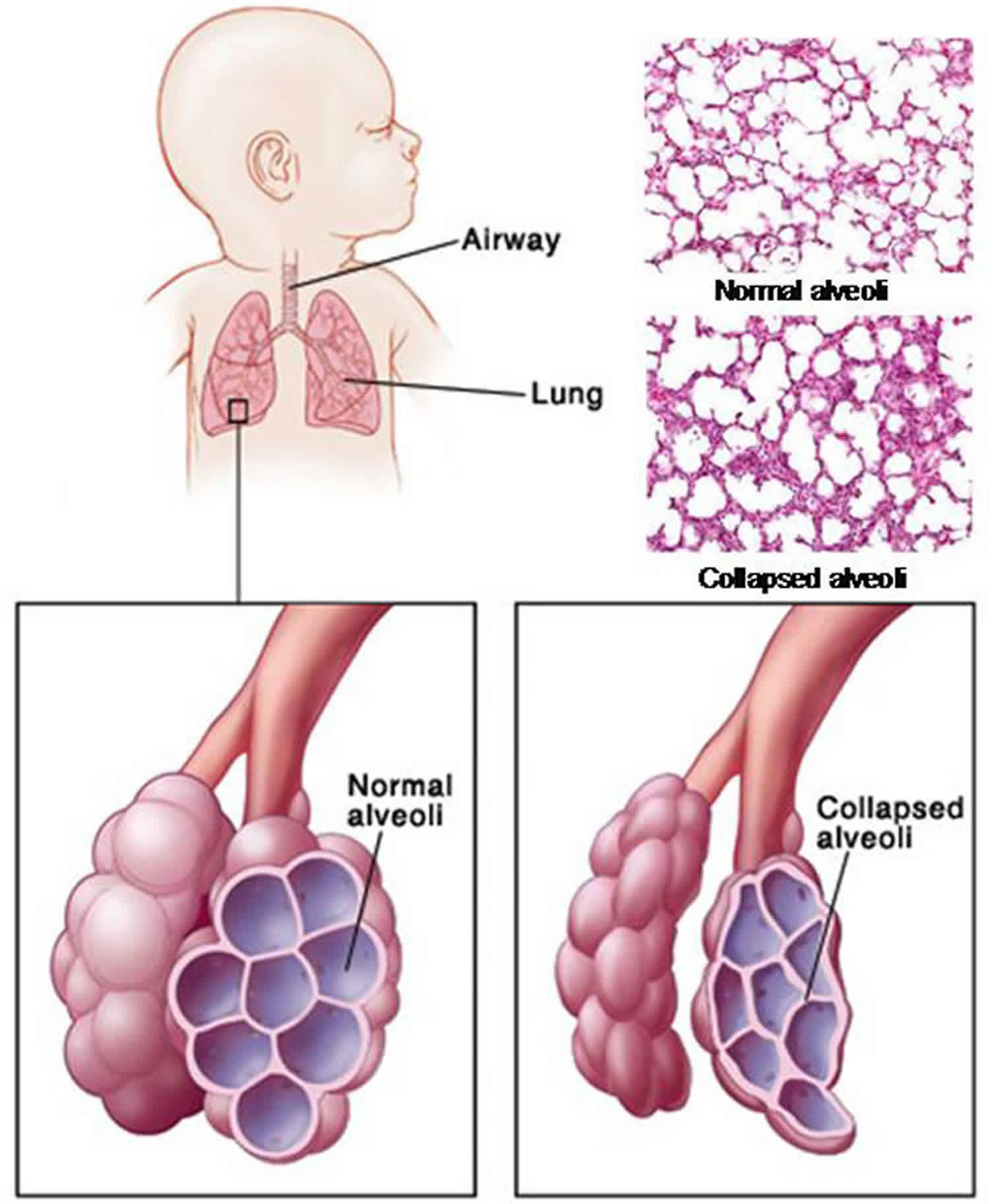 researchers-continue-to-study-idiopathic-pulmonary-fibrosis