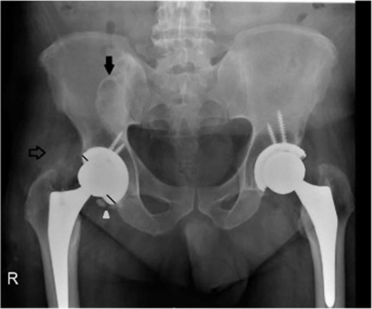 Metallosis Definition, Causes, Symptoms, Diagnosis & Treatment