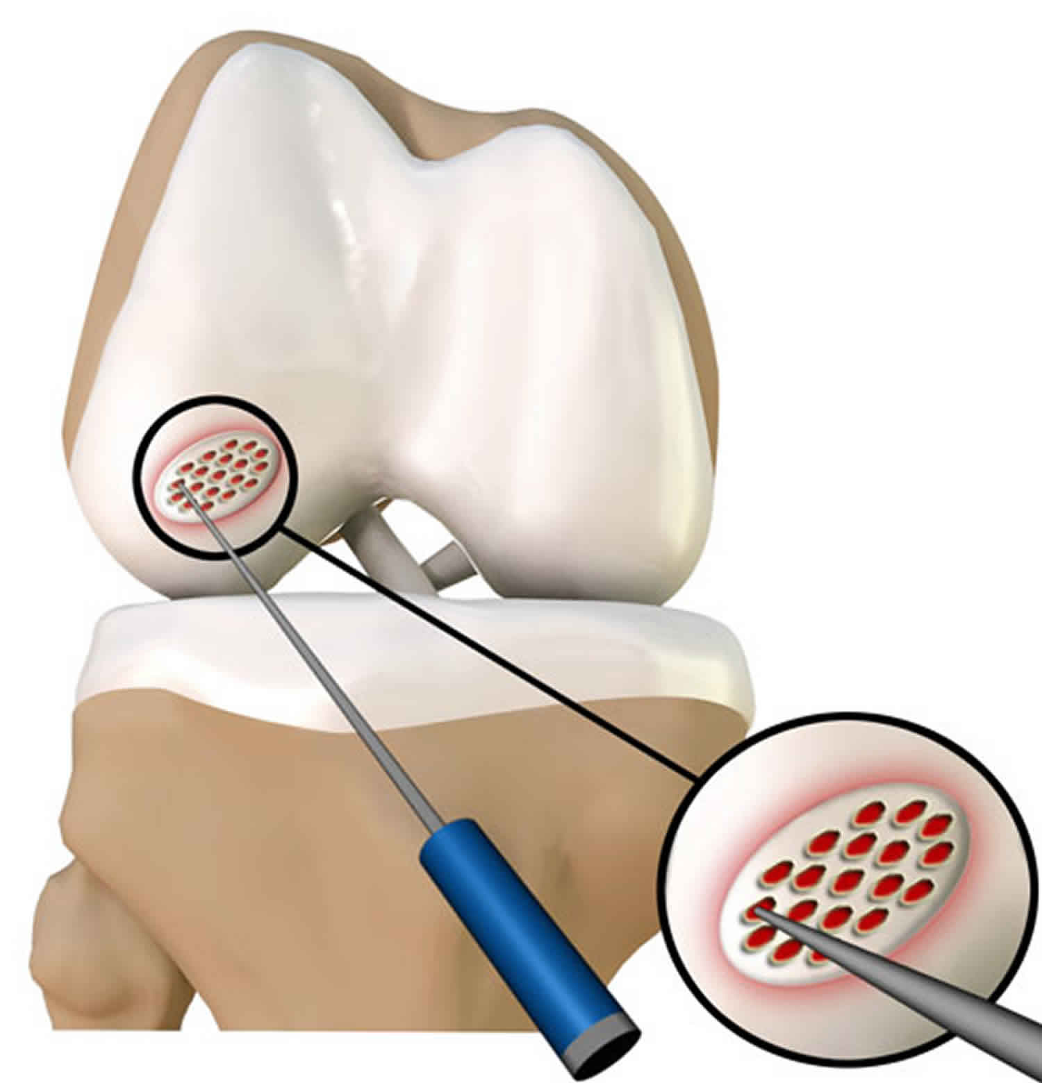 Microfracture Surgery Indications Recovery Success Rate