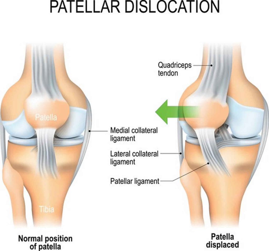 patellar-dislocation-causes-symptoms-diagnosis-treatment-prognosis