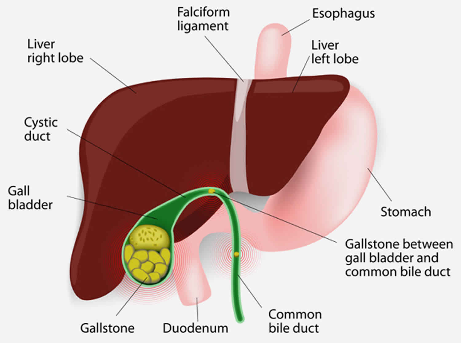 Pediatric Gallstones Causes Symptoms Diagnosis Treatment Prognosis