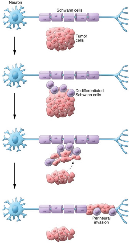 Perineural invasion & perineural spread definition & treatment