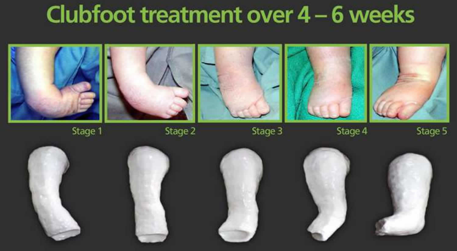 Ponseti Method For Clubfoot Treatment
