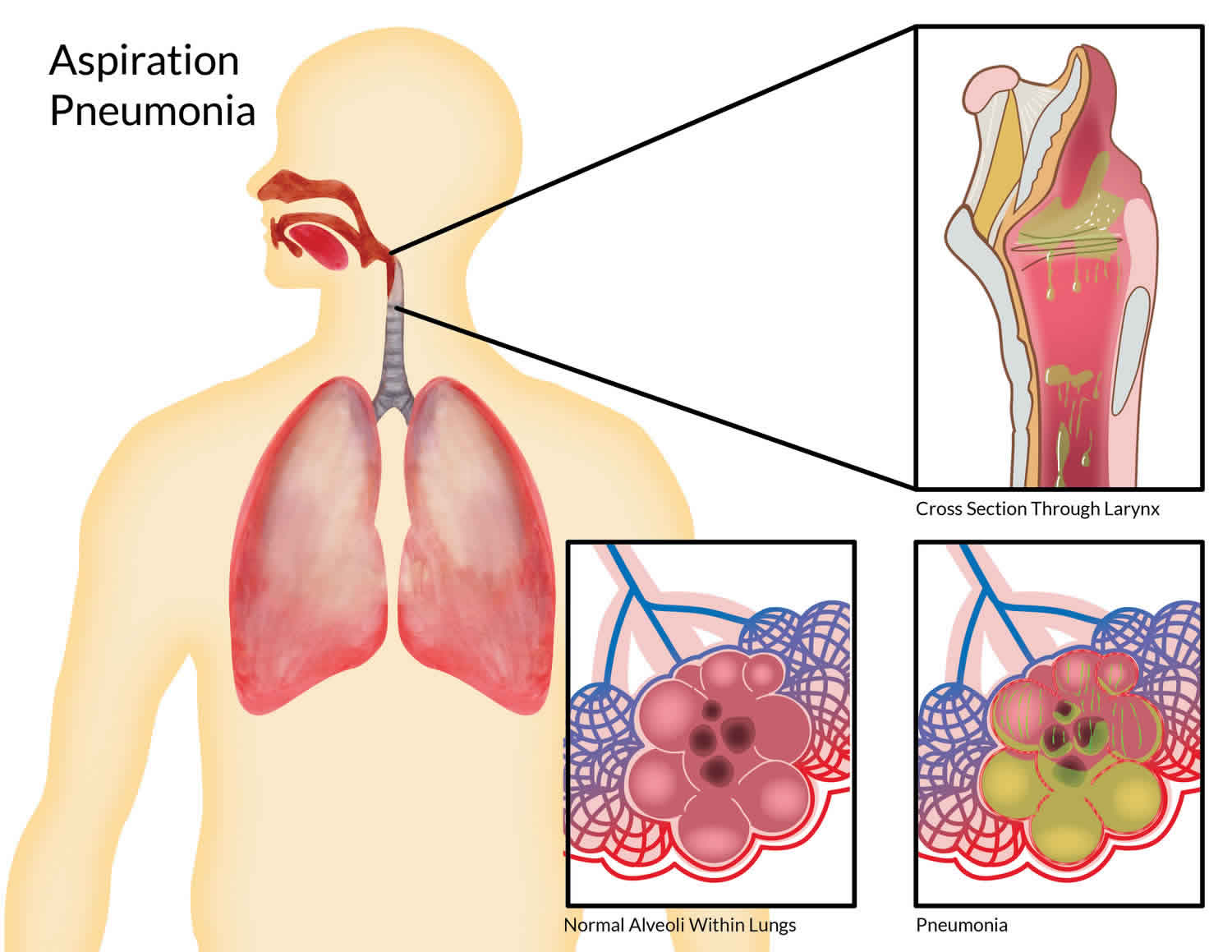 Pulmonary Aspiration Causes Symptoms Diagnosis Treatment Prognosis