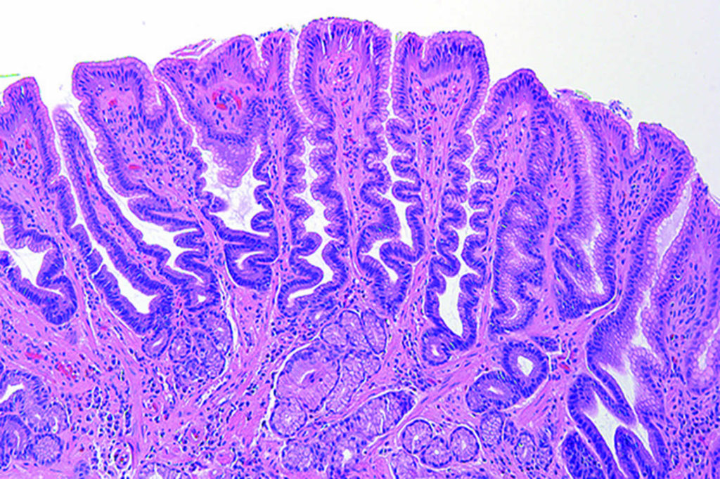 Reactive gastropathy definition, causes, symptoms, diagnosis & treatment