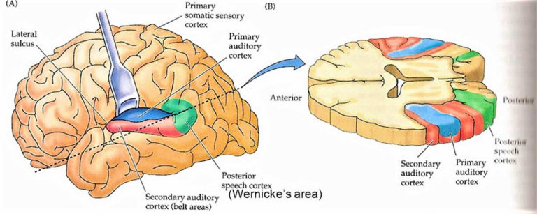 auditory cortex damage