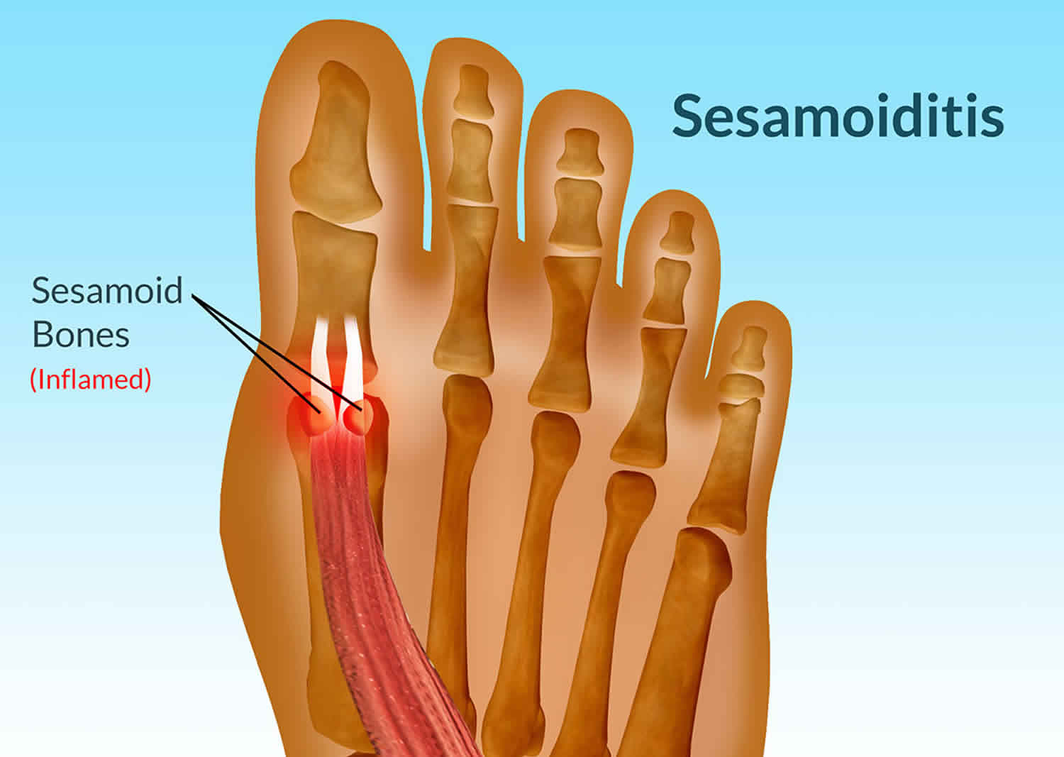 Sesamoiditis Causes Symptoms Diagnosis Treatment