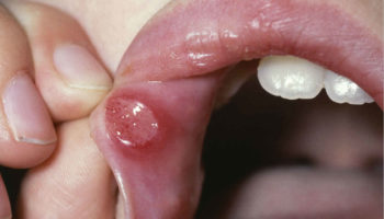 stomatitis