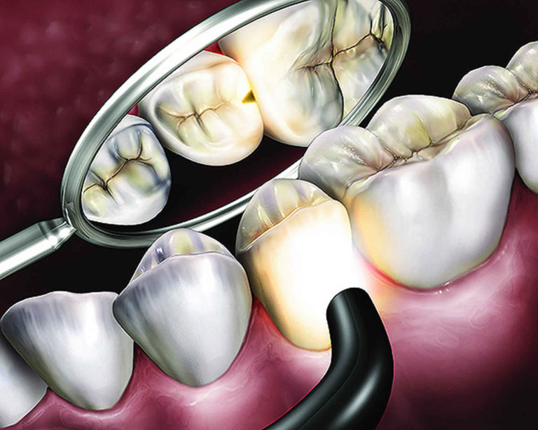 Transillumination test & transillumination dental