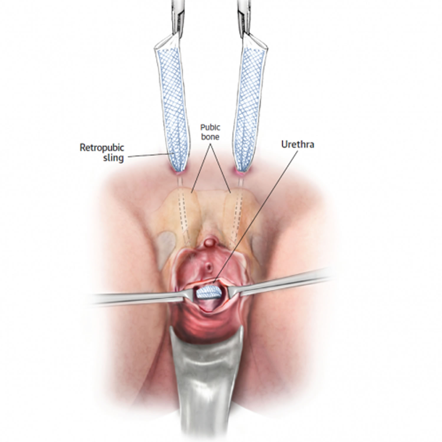 Urethral sling procedure or mid urethral sling surgery, risk