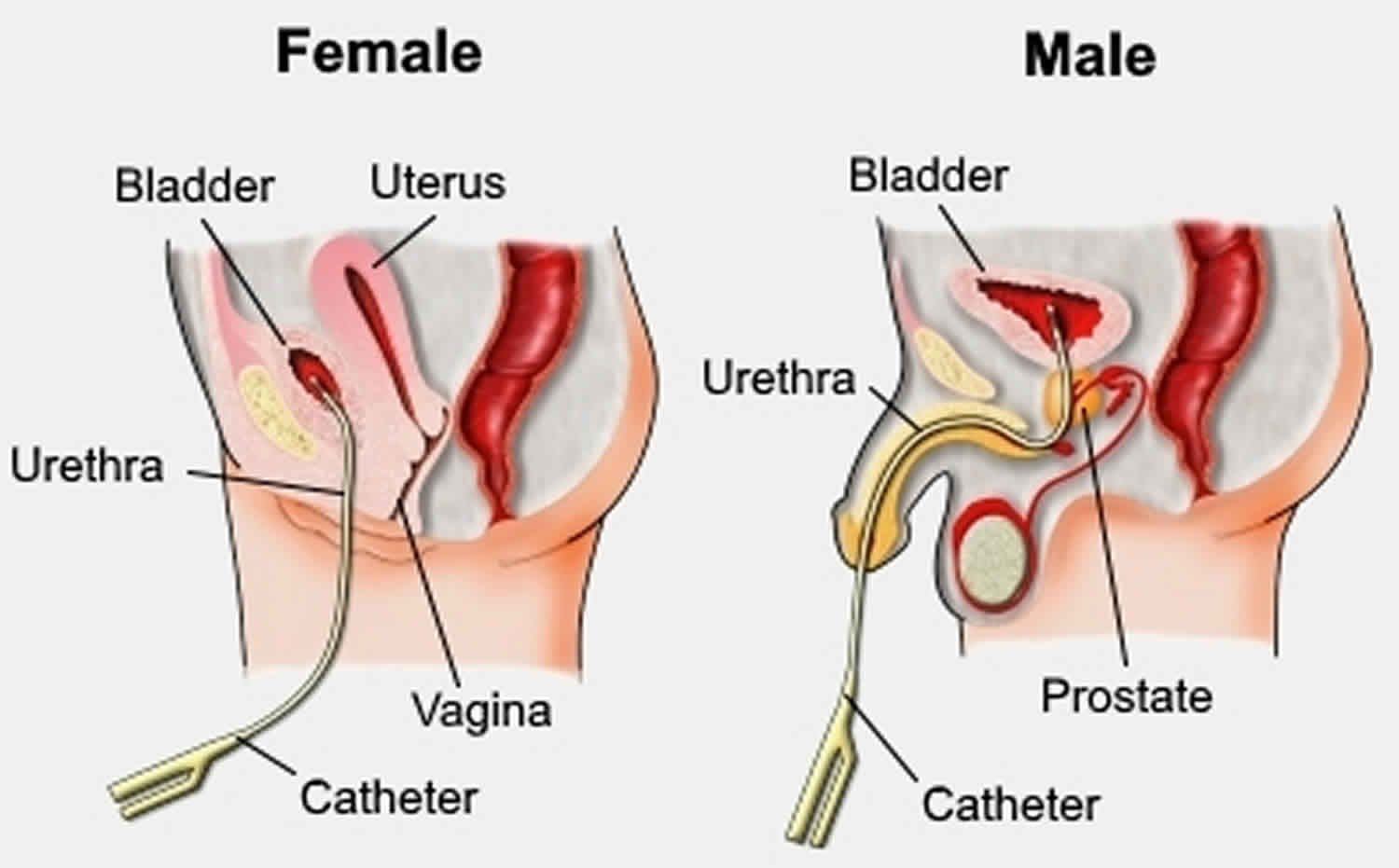 Urinary Catheterization In Pussy