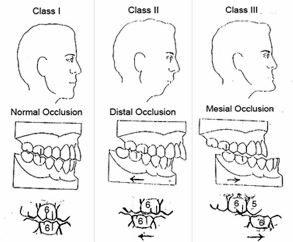 Angle Class 1 Malocclusion