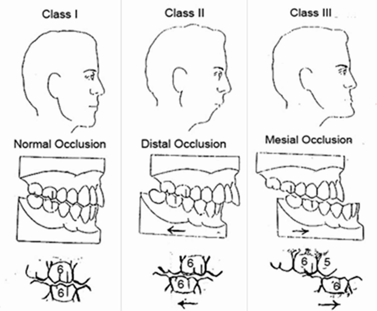 Angle's classification of malocclusion