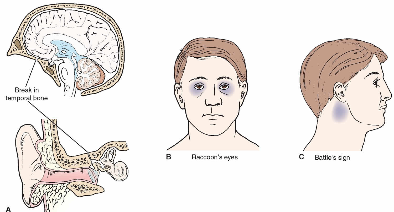 Battle sign definition, causes, diagnosis & treatment