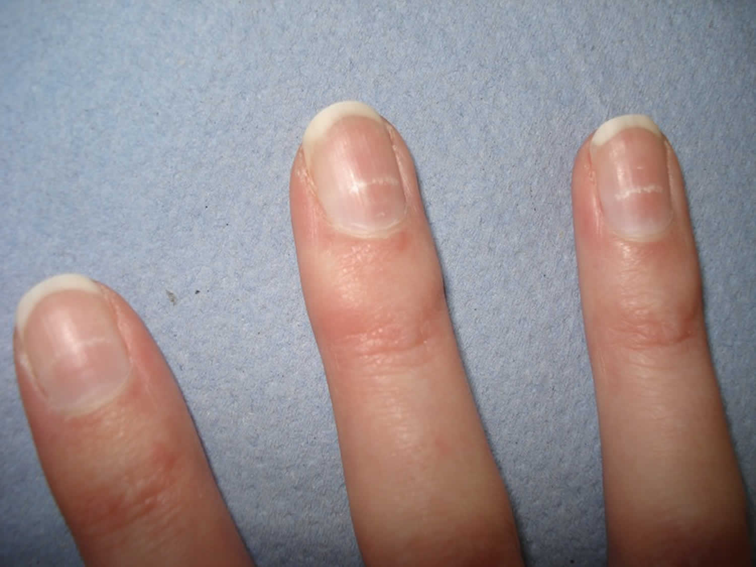Nail tread | definition of nail tread by Medical dictionary