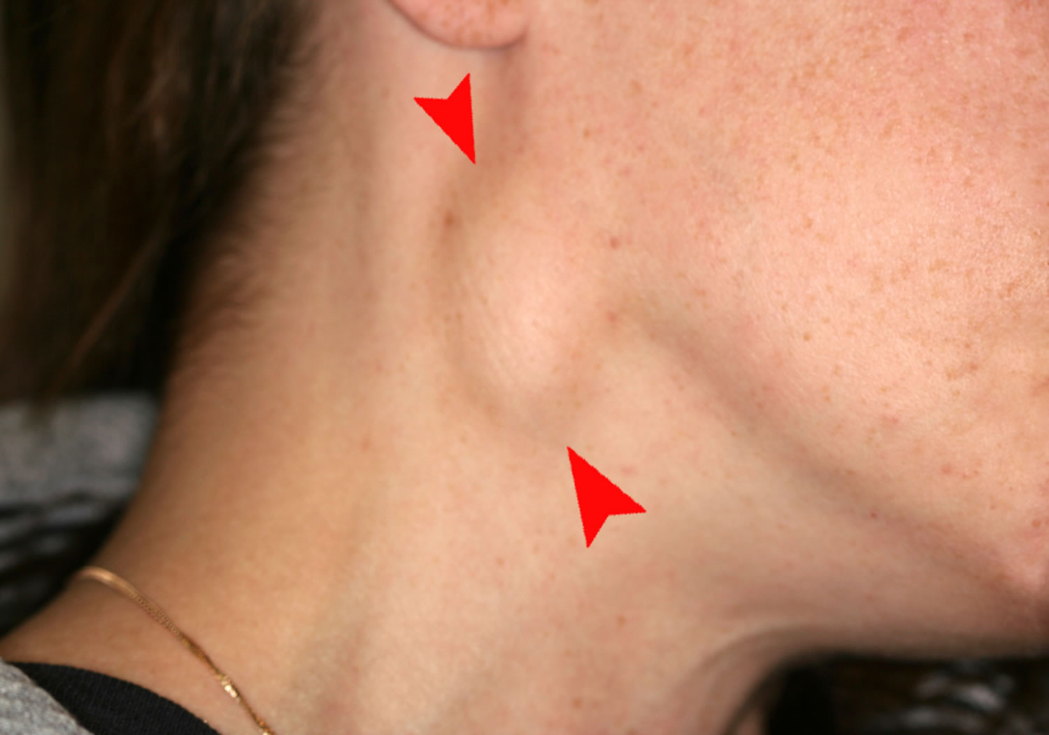 are lymph nodes along back of neck