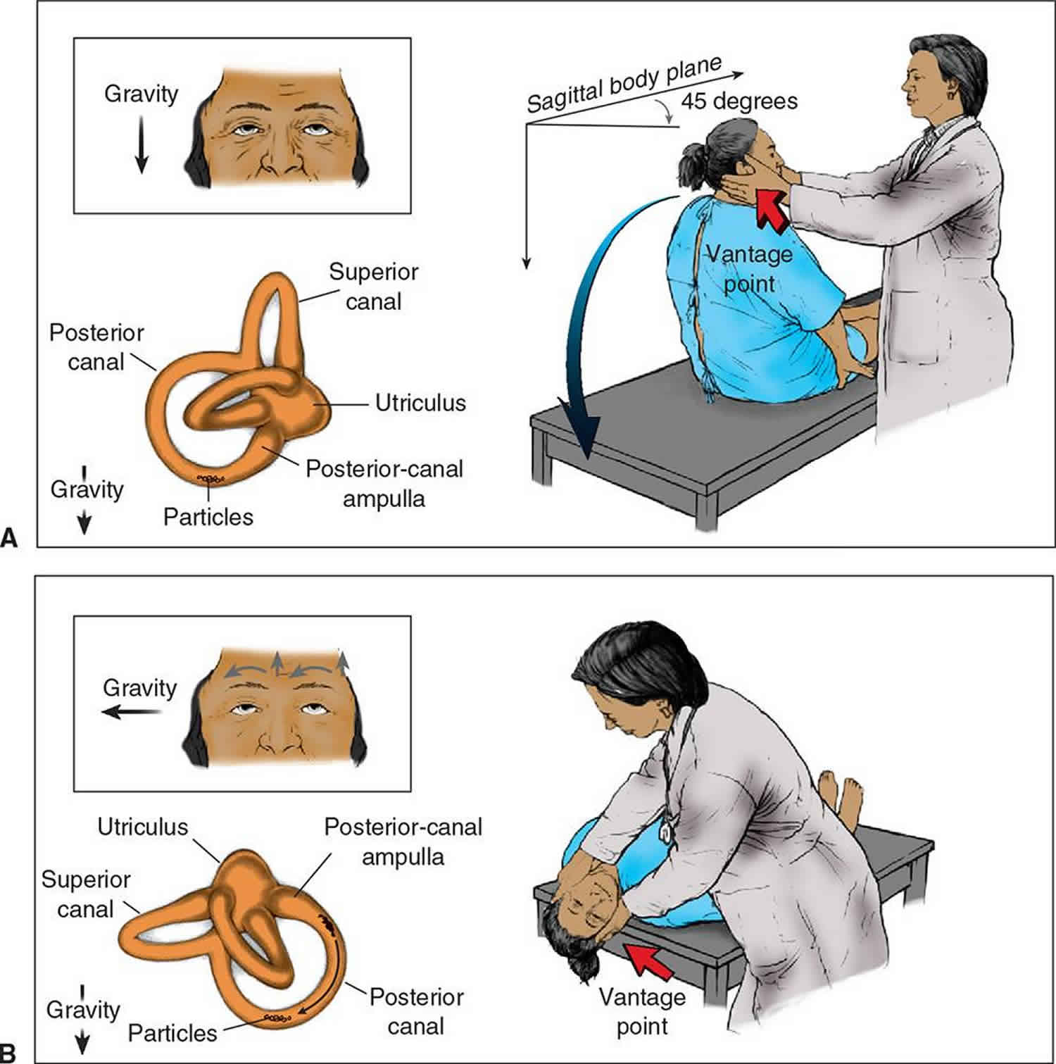 vertigo epley maneuver videos