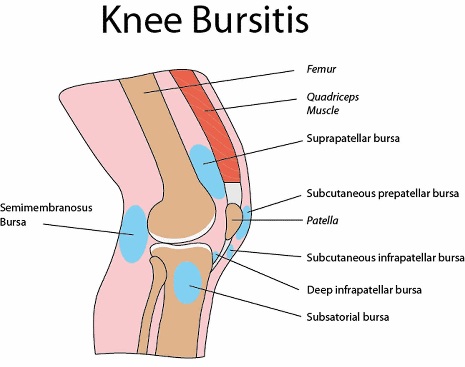 Bursita genunchiului: cauze, simptome, tratament