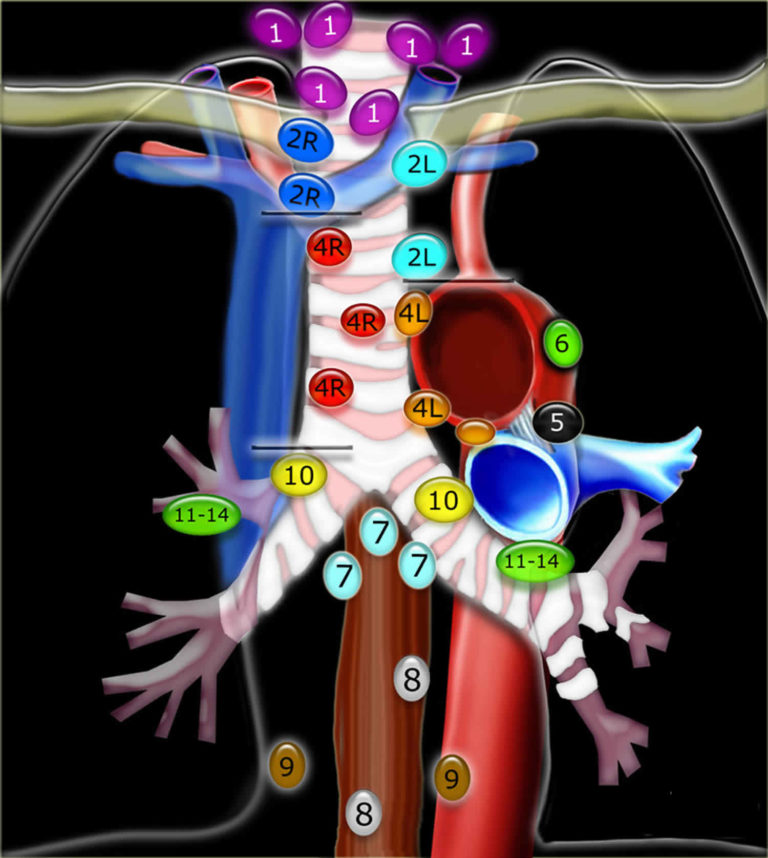 Mediastinal lymph nodes, mediastinal lymphadenopathy causes