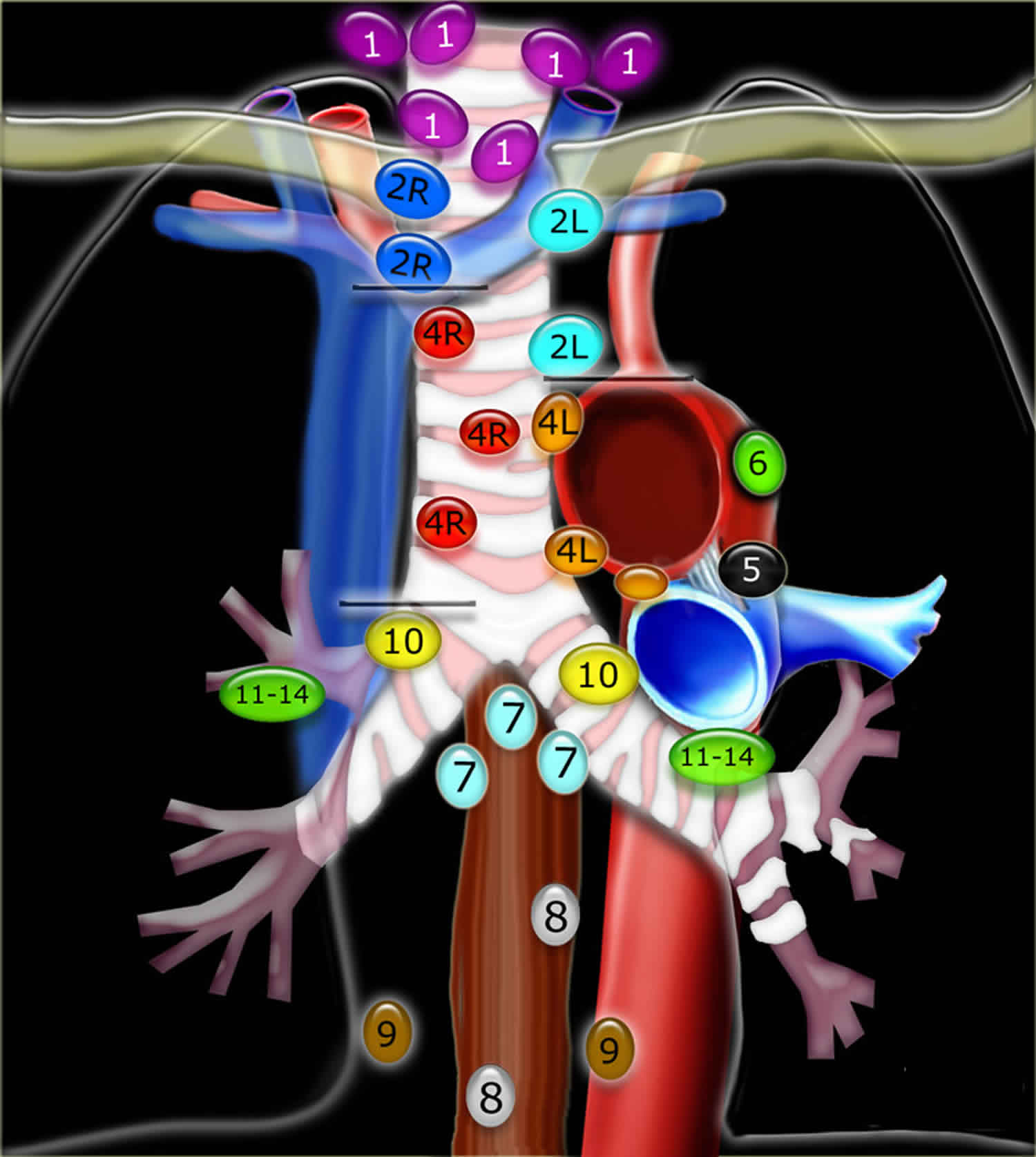 Mediastinal Lymph Nodes Mediastinal Lymphadenopathy Causes