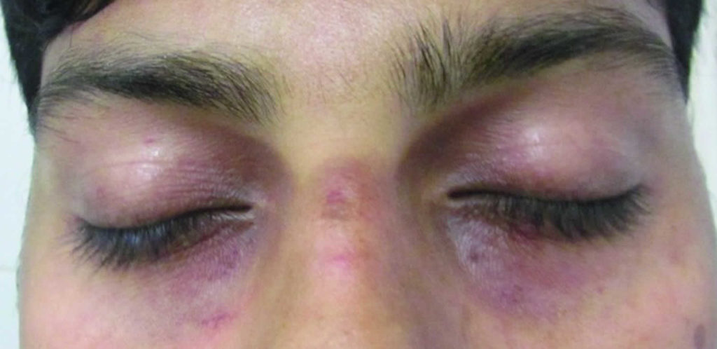 Dark circles under eyes causes &amp; dark circles under eyes