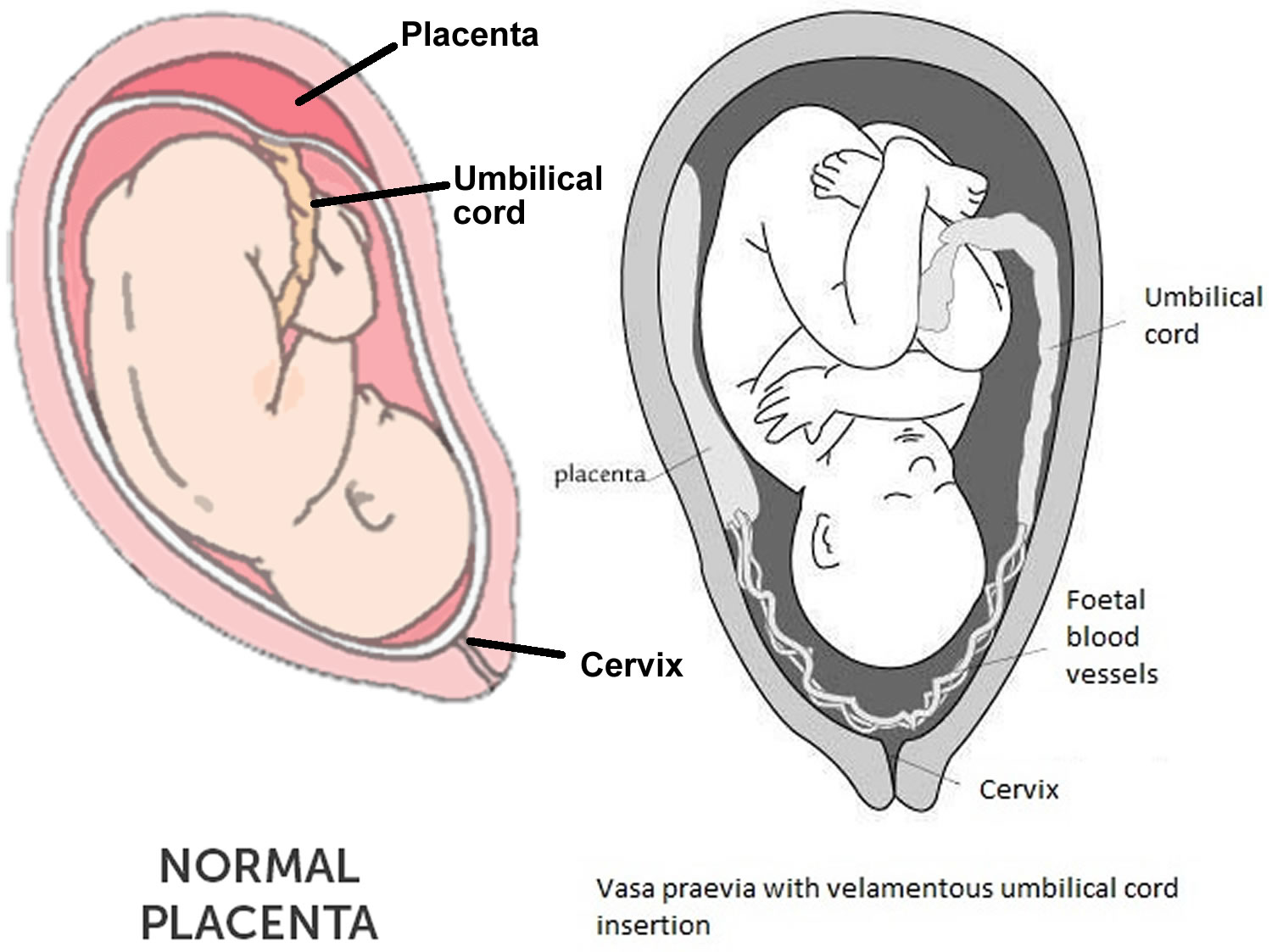 13 неделе беременности плацента. Vasa previa предлежание сосудов. Предлежание плаценты. Плацента перекрывает внутренний зев.