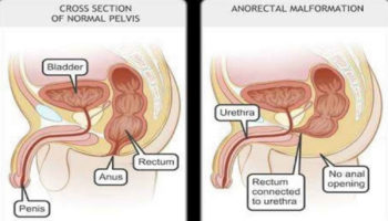 anorectal malformation