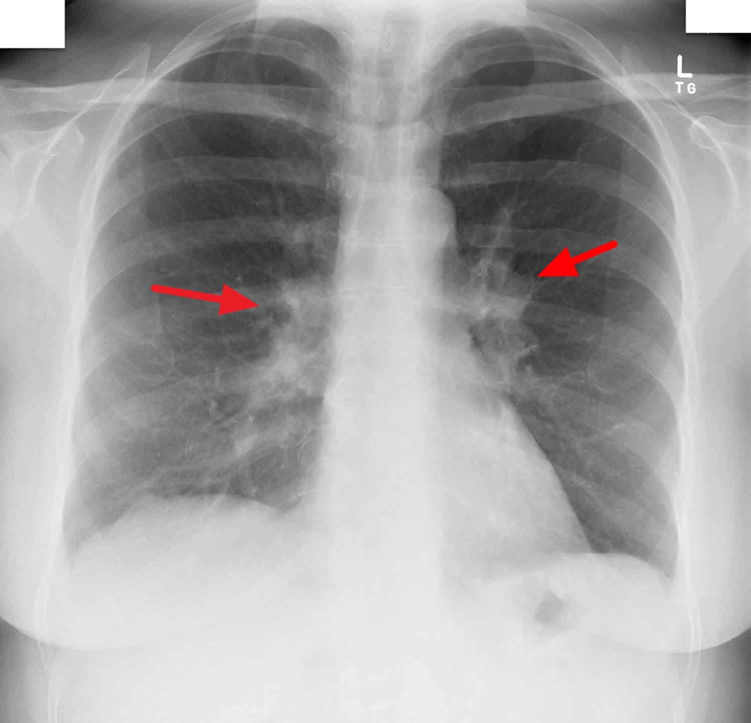 Chest X Ray Showing Bilateral Hilar Lymphadenopathy In A Patient With ...