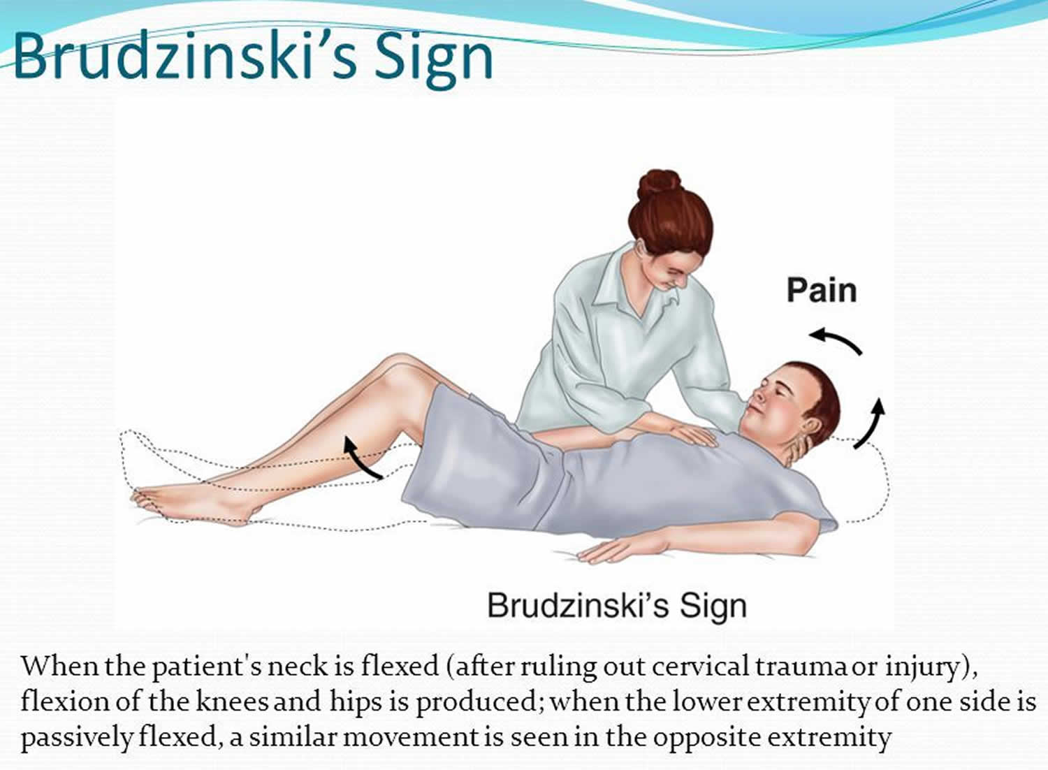 brudzinski's sign