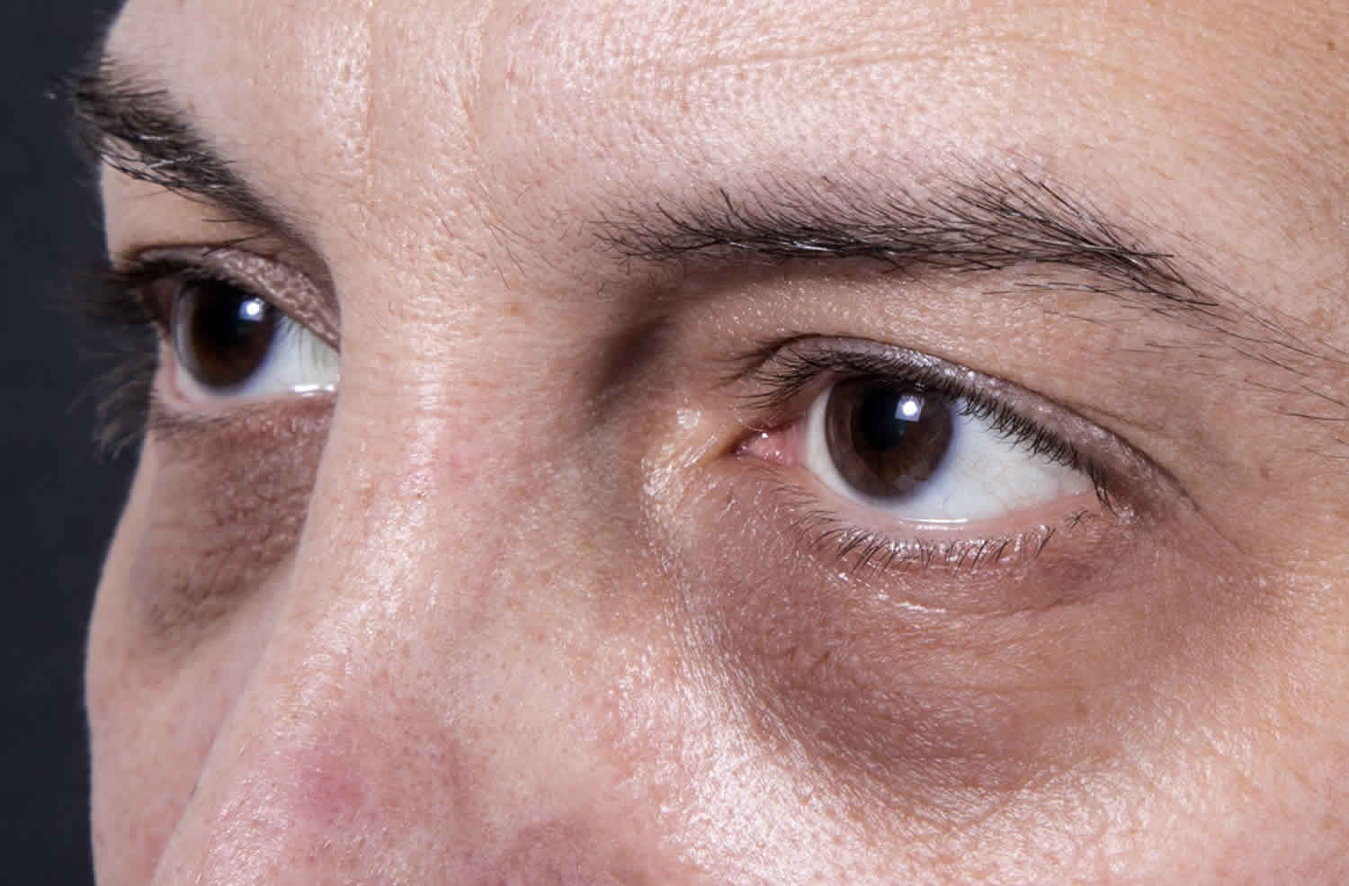 How to Get Rid of Dark Circles Under Eyes  Scar Under Eye