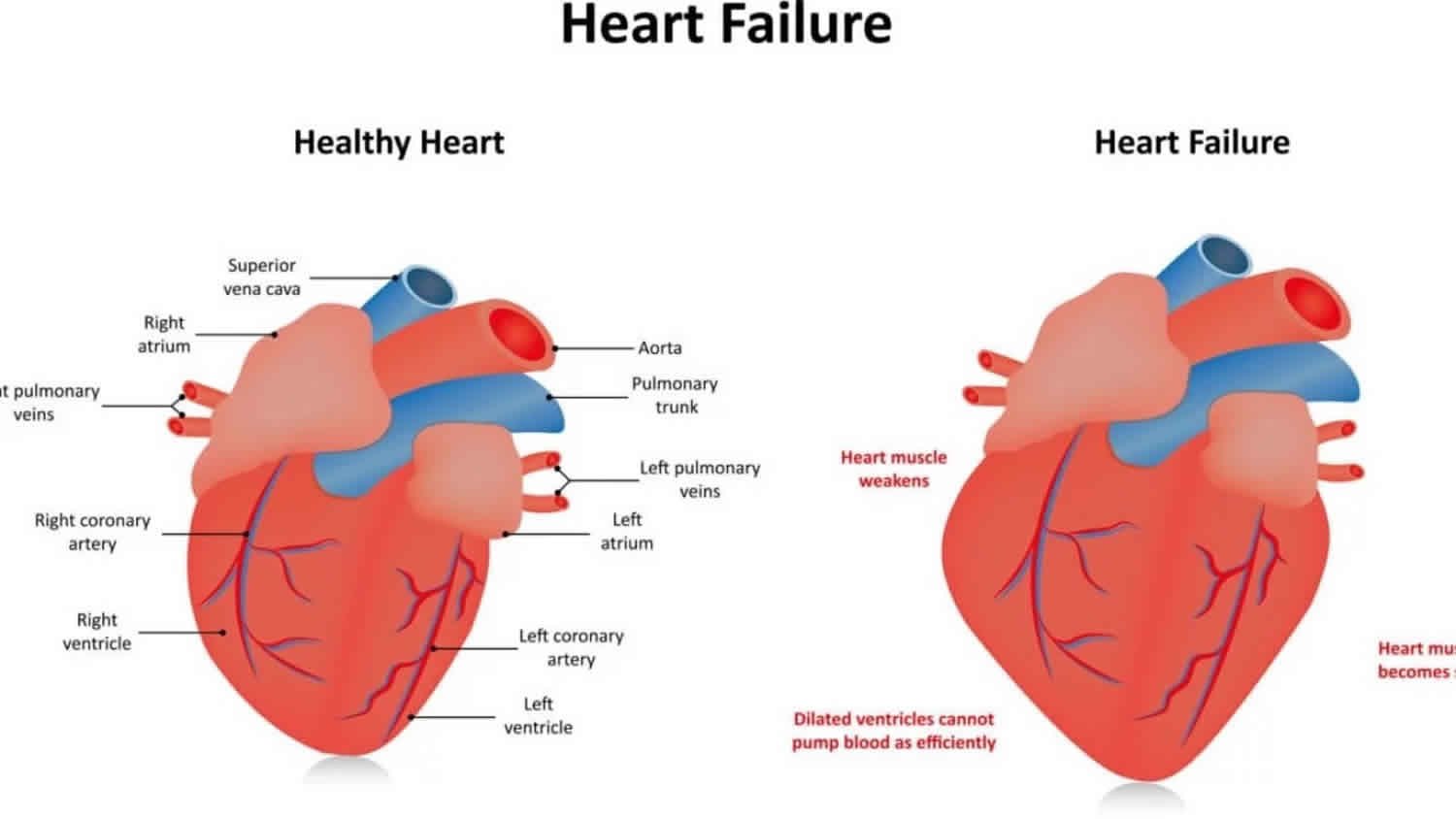 What Is Global Left Ventricular Hypokinesis - QLABOL