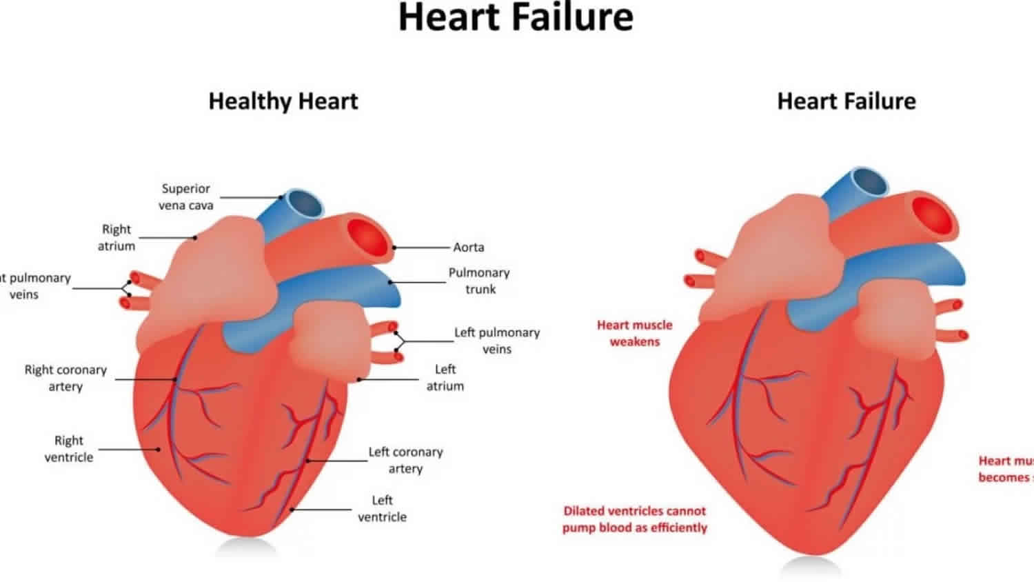 Global Hypokinesia of heart - Dr. Pradhan Homeopathy