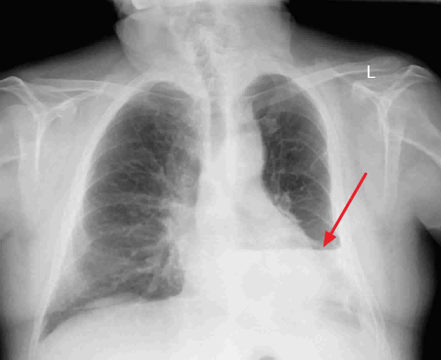 Pneumothorax Hemothorax