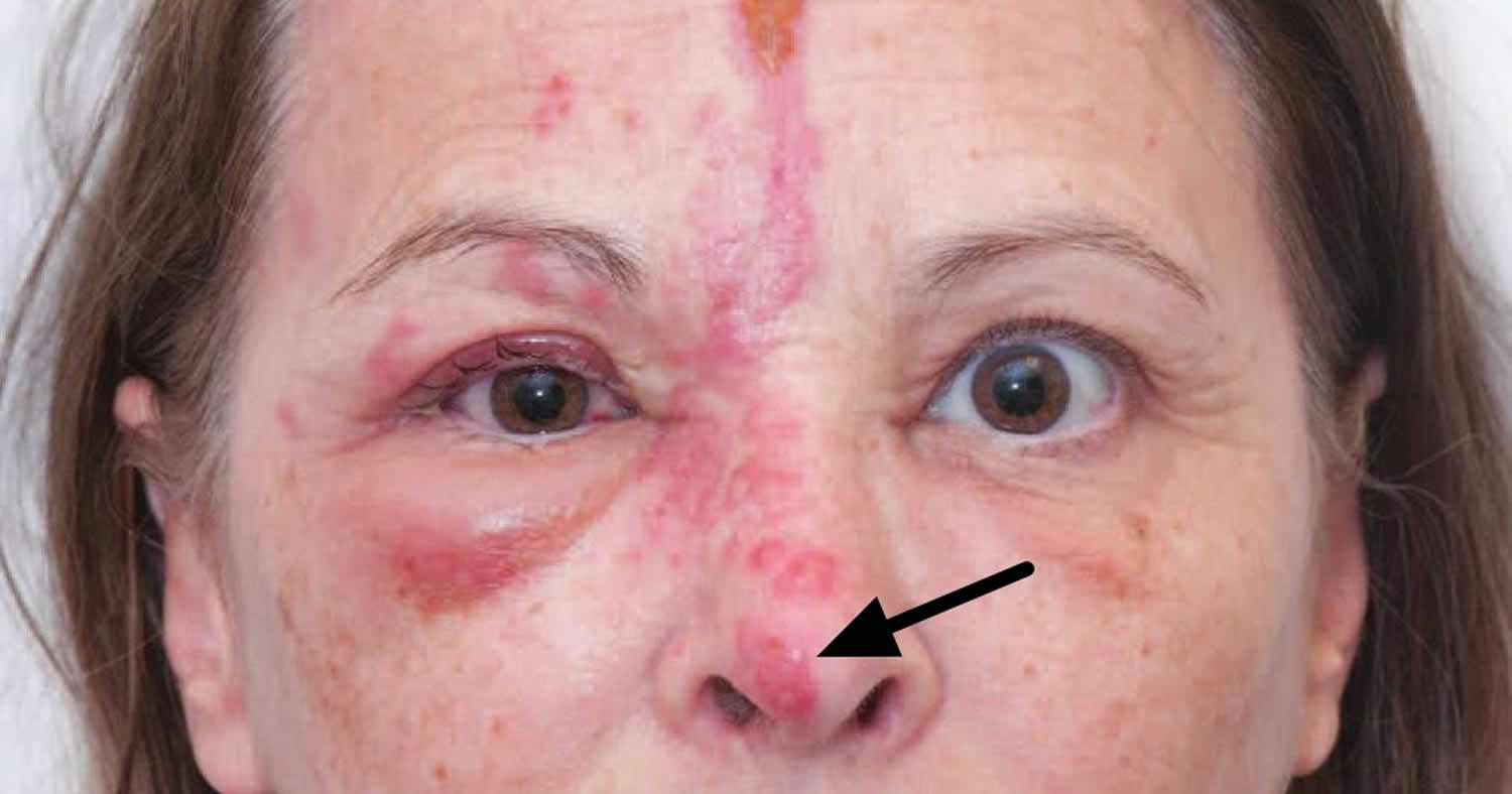 Herpes Zoster Ophthalmicus Hutchinson Sign