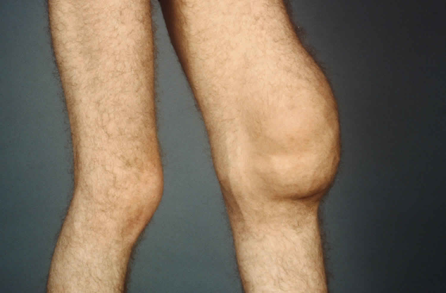 knee effusion treatment