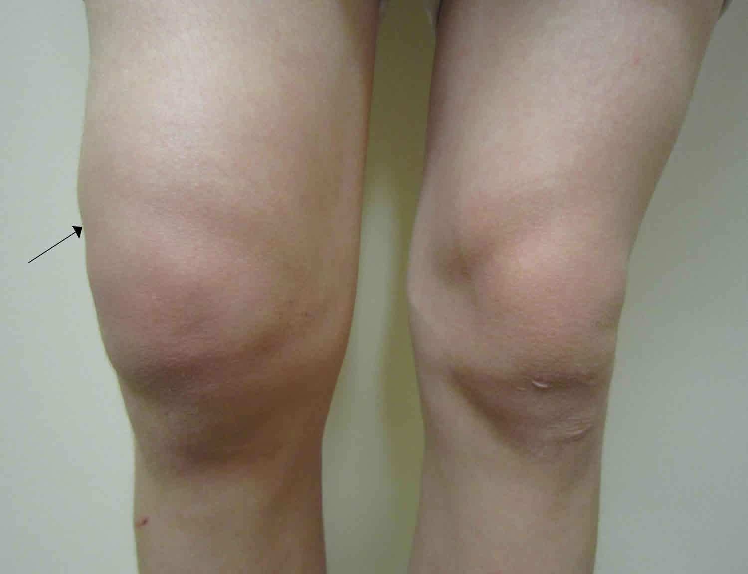 knee effusion treatment