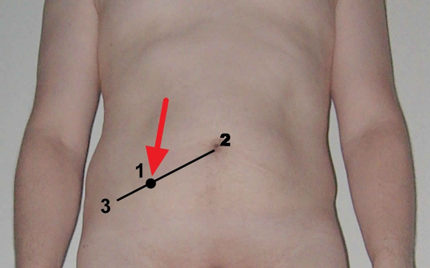 mcburney-s-point-location-causes-of-mcburney-s-point-tenderness