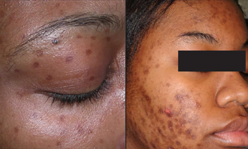Hyperpigmentation causes, hyperpigmentation treatment