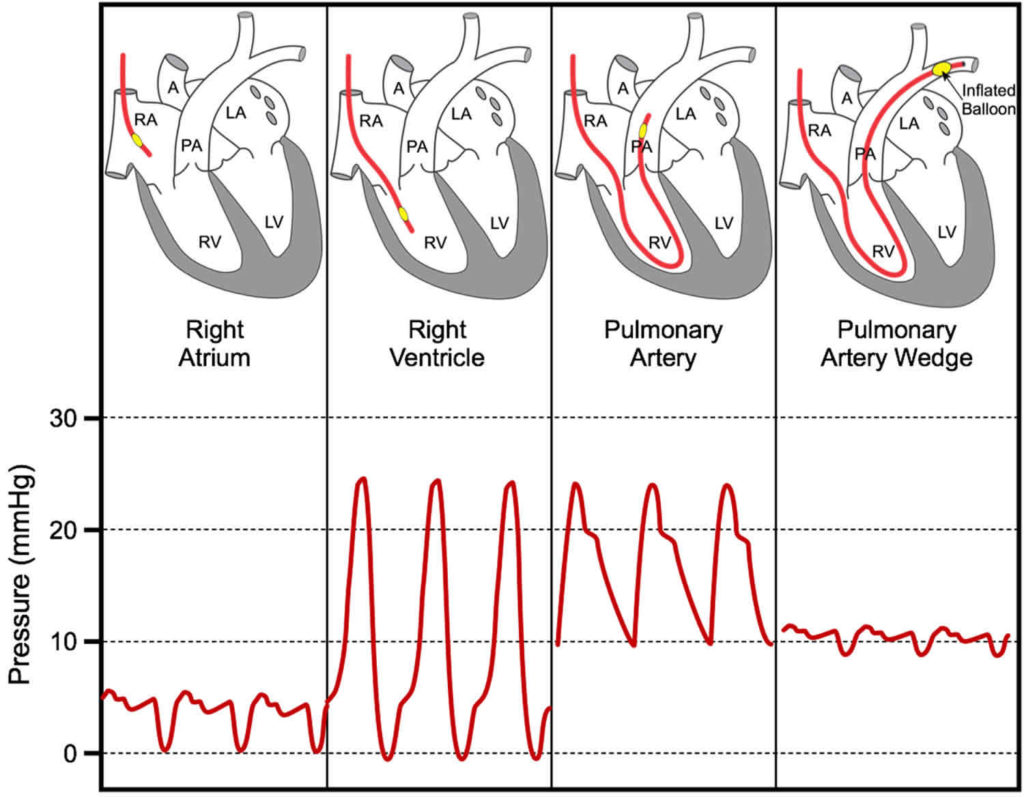 pulmonary artery wedge pressure meaning