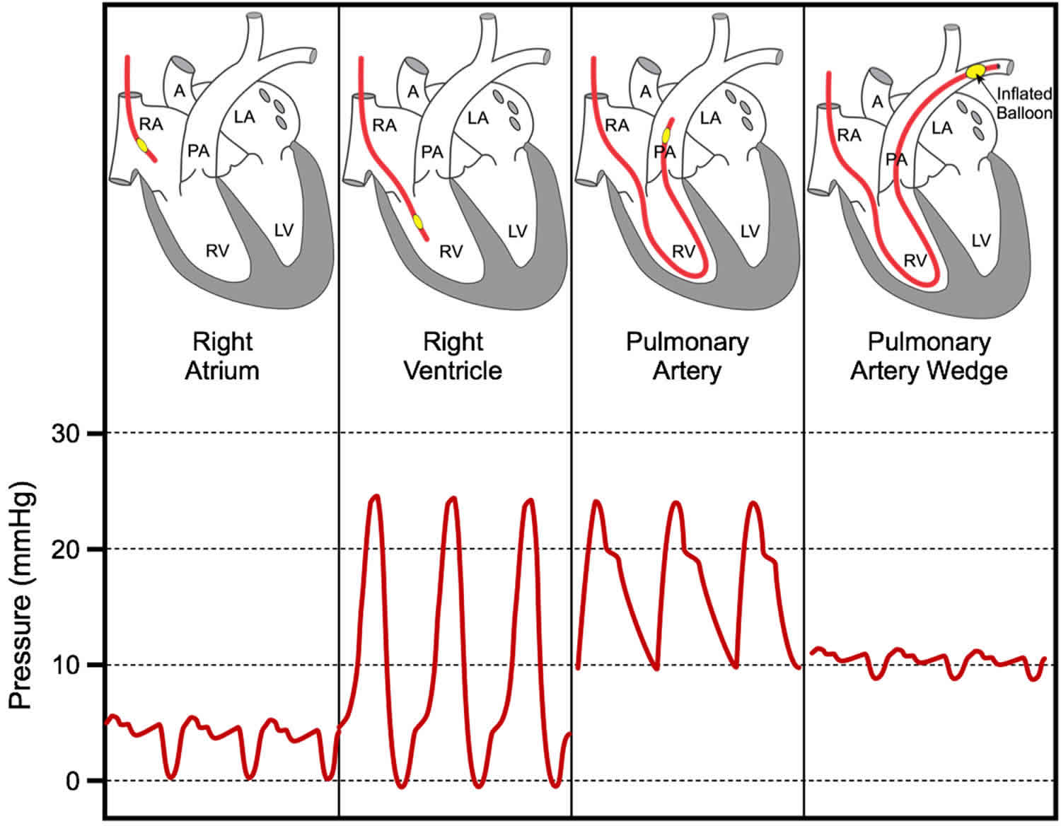 pulmonary wedge pressure falls before 12