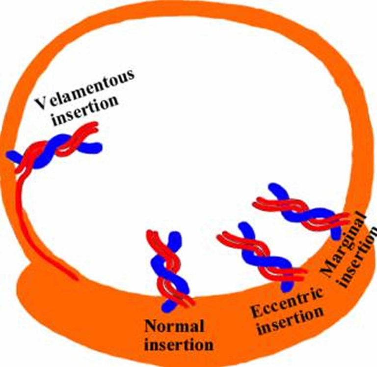 Velamentous cord insertion causes, risks, diagnosis & delivery