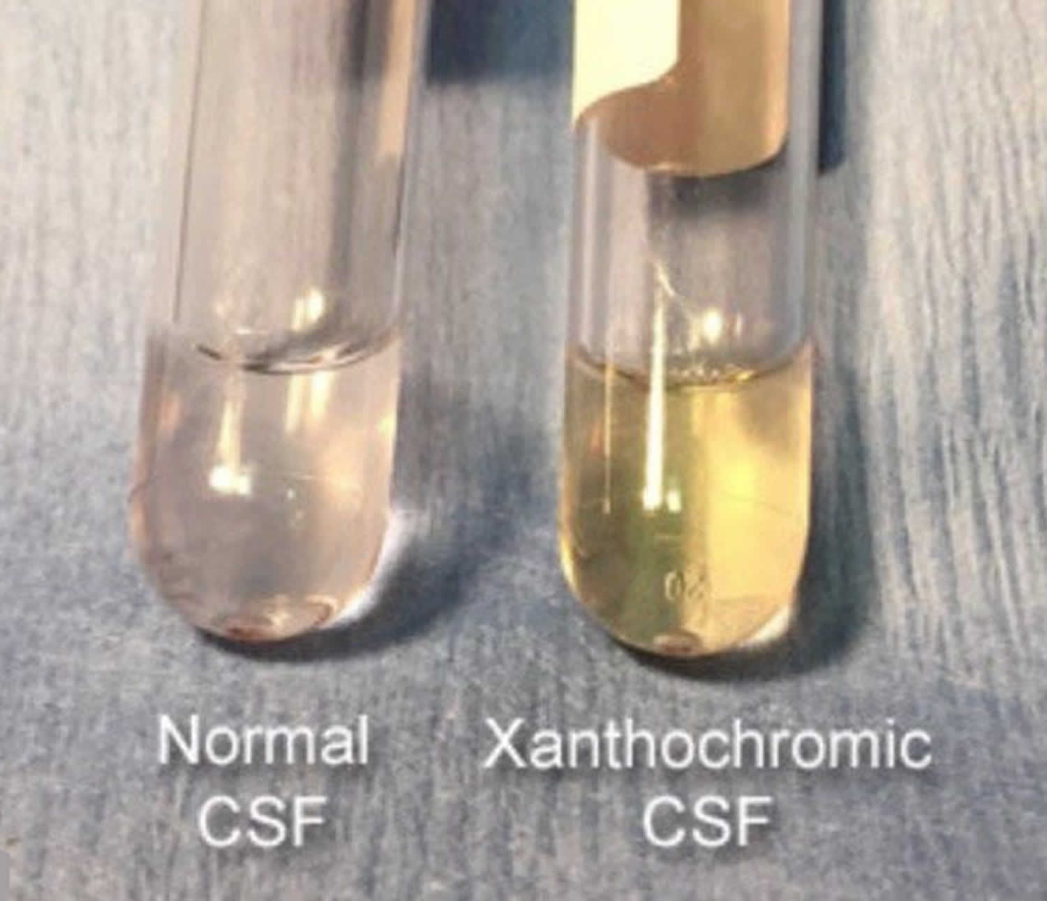 spinal fluid image