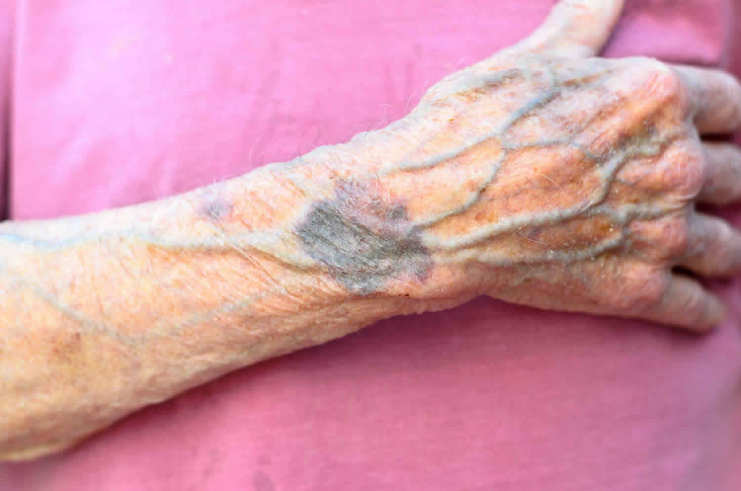 collapsed veins effects